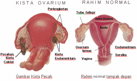 Yang perlu diketahui tentang Kista