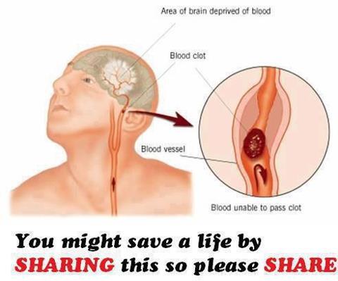 3 Langkah Mengidentifikasi Penyakit Stroke
