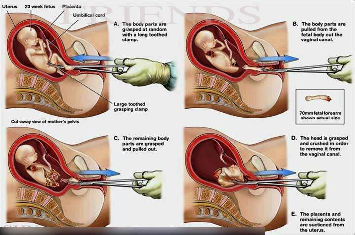 Aborsi.. Tahukah kamu?