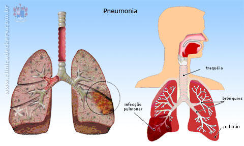 Pneumonia Pembunuh Bayi Terganas, Tapi Masih Disepelekan