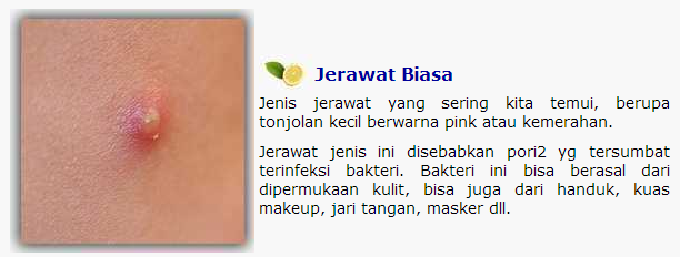 Ebook Program Intensif 21 Hari Menghilangkan Jerawat & Bekas Jerawat Secara Alami