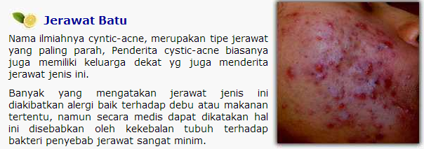 Ebook Program Intensif 21 Hari Menghilangkan Jerawat & Bekas Jerawat Secara Alami