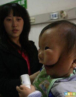 Bayi Lahir Dengan Dua Wajah