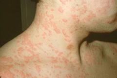 13 Penyakit dan Kelainan yang Belum Ada Obatnya &#91;Serba 13&#93;