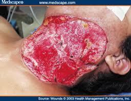 13 Penyakit dan Kelainan yang Belum Ada Obatnya &#91;Serba 13&#93;