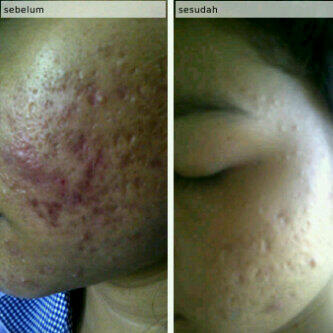 NANO SPRAY !!! SOLUSI MASALAH KULIT UNTUK COWO &amp; CEWE