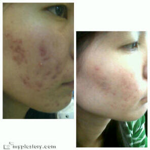 NANO SPRAY !!! SOLUSI MASALAH KULIT UNTUK COWO &amp; CEWE