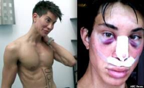 Justin Jedlica, Pria dgn 90 Oprasi Plastik