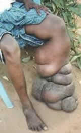 10 penyakit langka paling aneh di dunia 