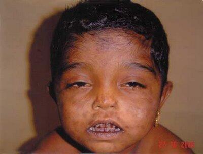 10 penyakit langka paling aneh di dunia 