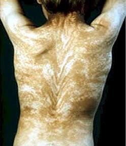 10 penyakit langka paling aneh di dunia 