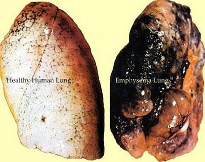 Seberapa Efektifkah Busa Rokok Mengurangi Bahaya Asap Rokok?