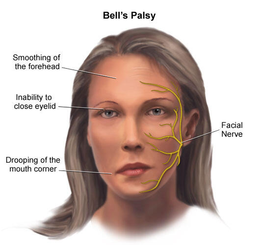 PENYAKIT YG ORANG JARANG TAHU (BELL'S PALSY)