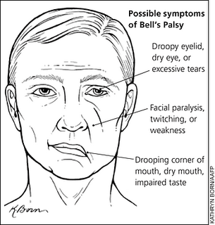 PENYAKIT YG ORANG JARANG TAHU (BELL'S PALSY)