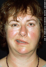 PENYAKIT YG ORANG JARANG TAHU (BELL'S PALSY)