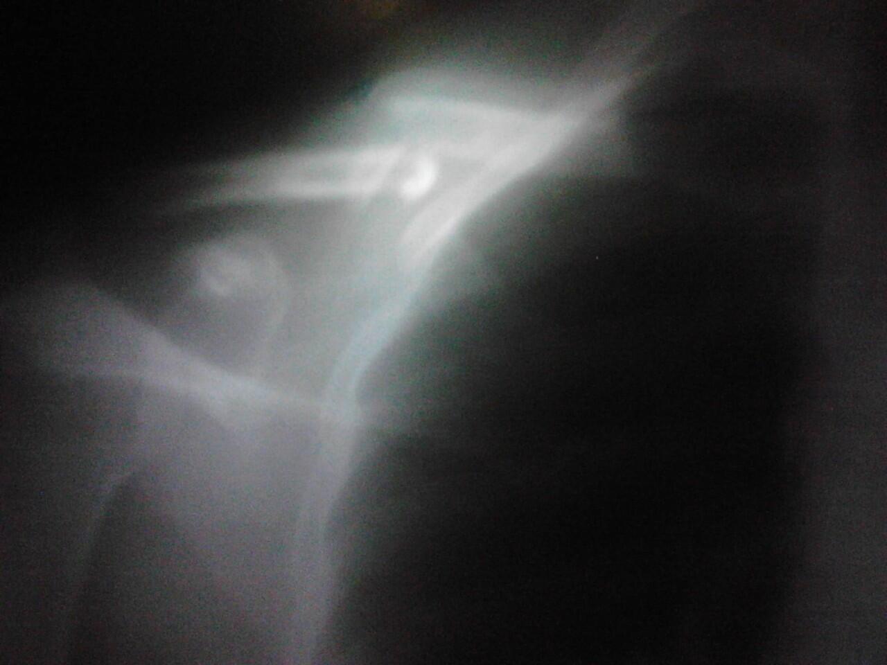 &#91;ASK&#93; patah tulang selangka / clavicle / clavicula