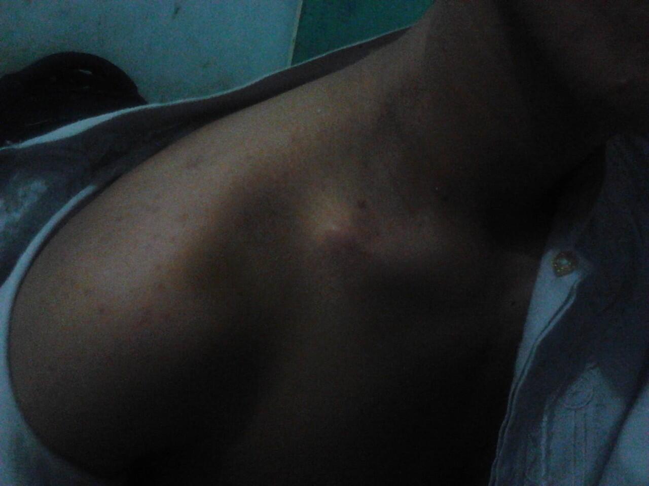 &#91;ASK&#93; patah tulang selangka / clavicle / clavicula