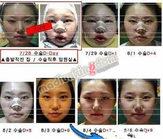 Proses Operasi Plastik, Rahasia Kecantikan Artis Korea