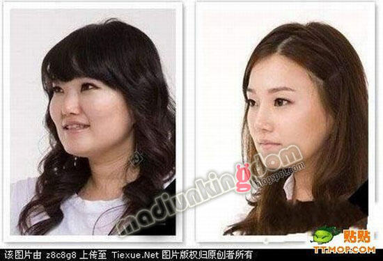 Proses Operasi Plastik, Rahasia Kecantikan Artis Korea