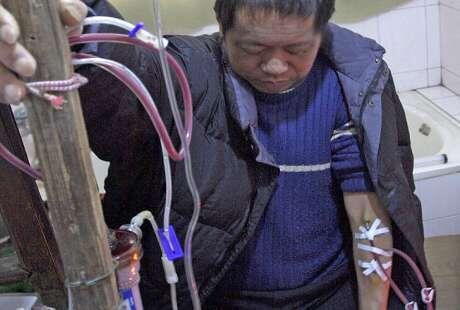 Wow, Pria China Bertahan Hidup 13 Tahun Berkat Alat Cuci Darah Buatan Sendiri