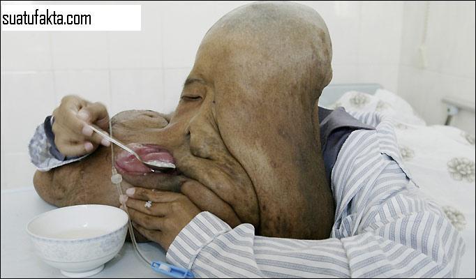 Foto Korban Tumor Yang Mengerikan