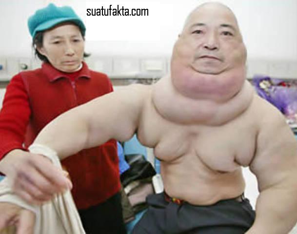Foto Korban Tumor Yang Mengerikan