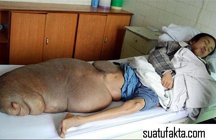 Foto Korban Tumor Yang Mengerikan