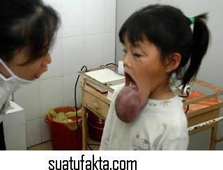 Foto Korban Tumor Yang Mengerikan