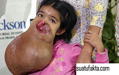 Foto Korban Tumor Yang Mengerikan