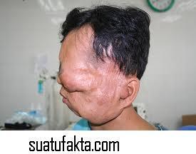 Foto Korban Tumor Yang Mengerikan