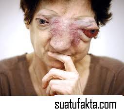 Foto Korban Tumor Yang Mengerikan