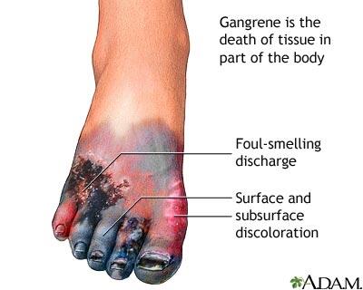Mengenal Penyakit Gangrene