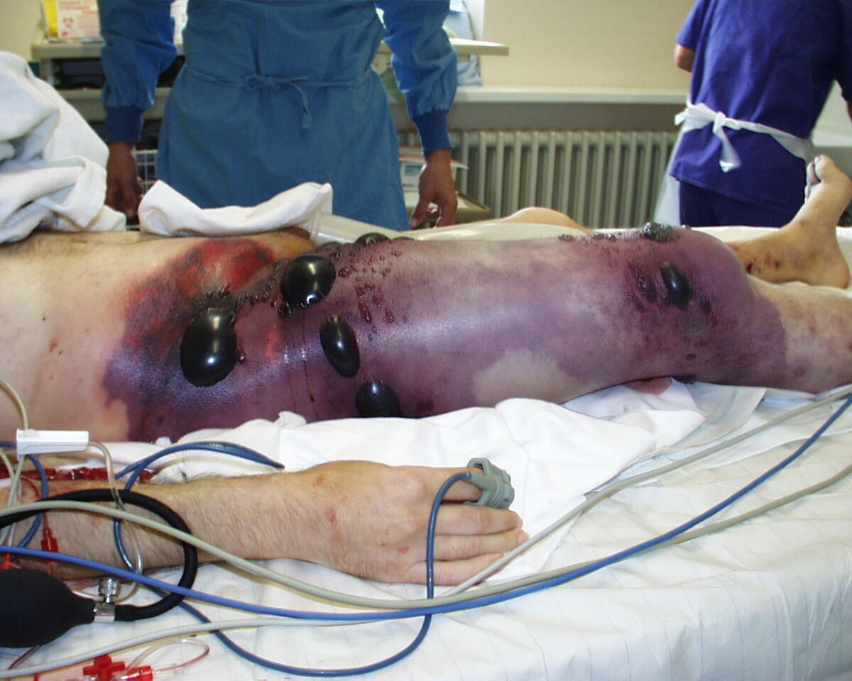 Mengenal Penyakit Gangrene