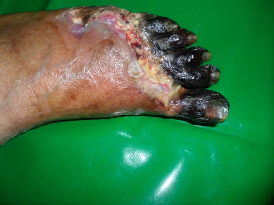 Mengenal Penyakit Gangrene