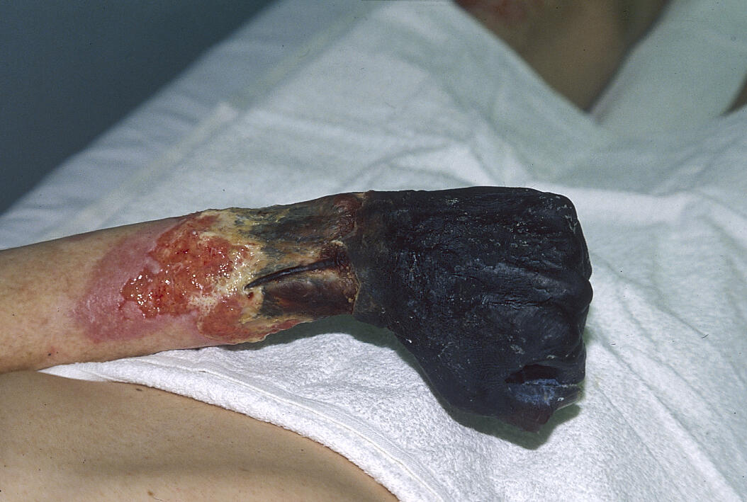 Mengenal Penyakit Gangrene
