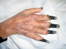 Mengenal Penyakit Gangrene