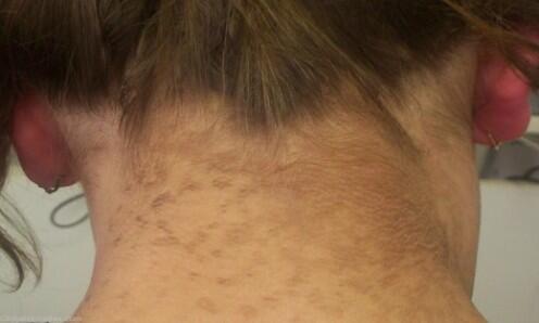 7 Cara Mengobati Penyakit Acanthosis Nigricans