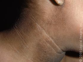 7 Cara Mengobati Penyakit Acanthosis Nigricans