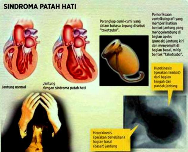 Manusia bisa &quot;MATI&quot; karena patah hati