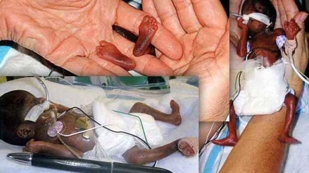 bayi-bayi yang terlahir dengan kondisi tubuh sangat ekstrem