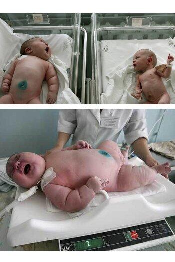 bayi-bayi yang terlahir dengan kondisi tubuh sangat ekstrem