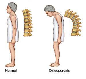 Kiat Menghindari Osteoporosis