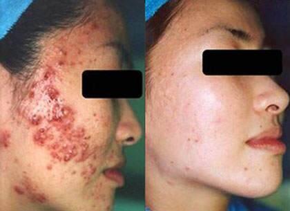 Mimba Salep untuk Jerawat, Keloid, Gatal-Gatal, dll