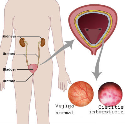 Cara mengatasi penyakit Infeksi kandung kemih... (Sistitis)