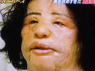Kecanduan Operasi Plastik,wajah wanita korea berubah menjadi Monster...