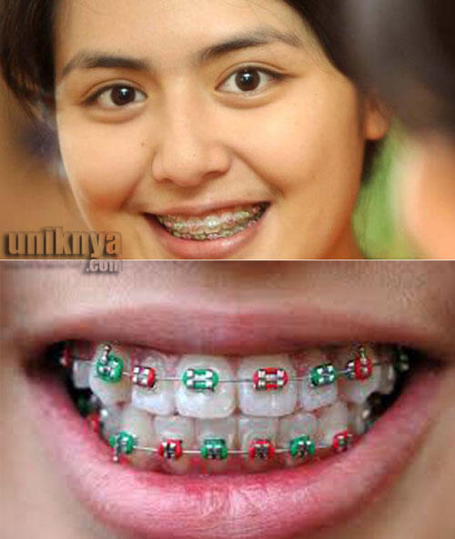 Kawat Gigi Palsu - ngeTREND Tapi BERBAHAYA!