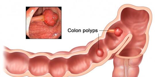 Waspadai 7 penyebab kanker usus besar