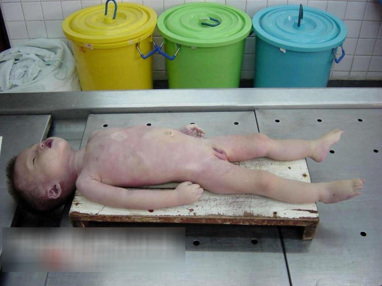 Baby boy autopsy