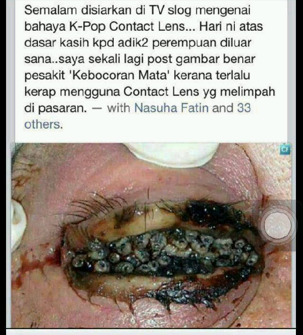 Akibat Dari Sering Memakai Softlens