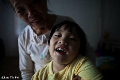 Foto Anak - Anak Korban Agent Orange Di Vietnam